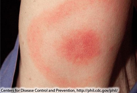 Classic Lyme disease rash: circular red rash with central clearing that slowly expands