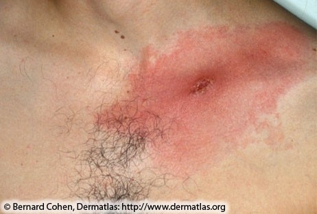 Red expanding rash with central crust