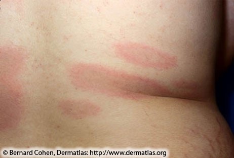 Early disseminated Lyme disease: multiple disseminated Lyme disease: multiple red lesions with dusky centers