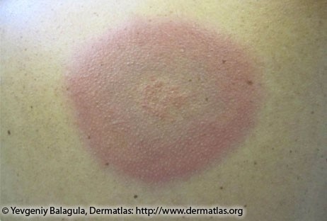 Red rash with bluish hue and no central clearing
